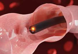 Polypectomy Treatment in Mohali| Livasa Hospital